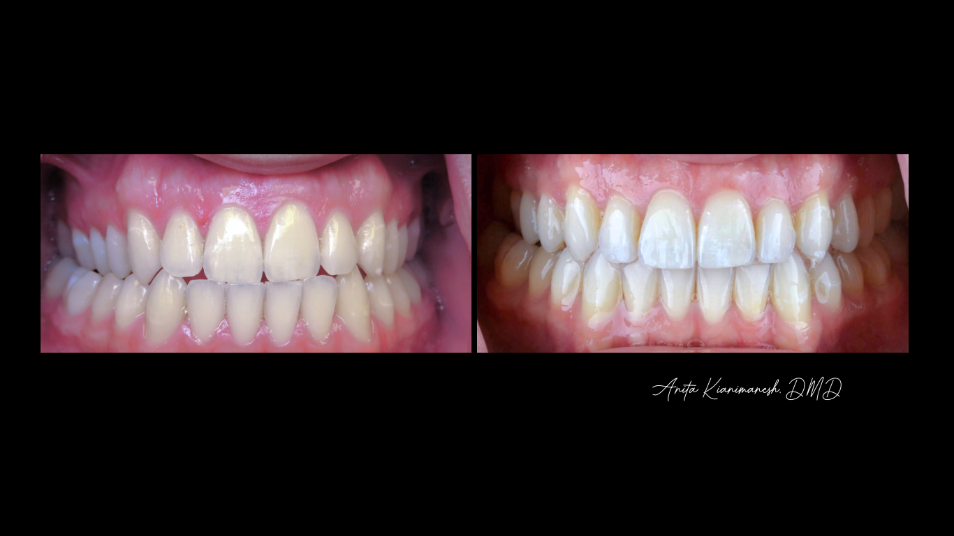 Invisalign 