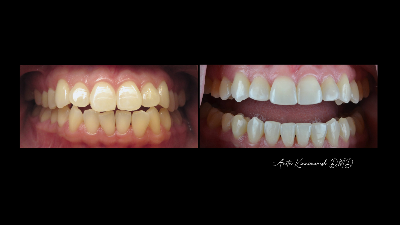 Invisalign and Bondings