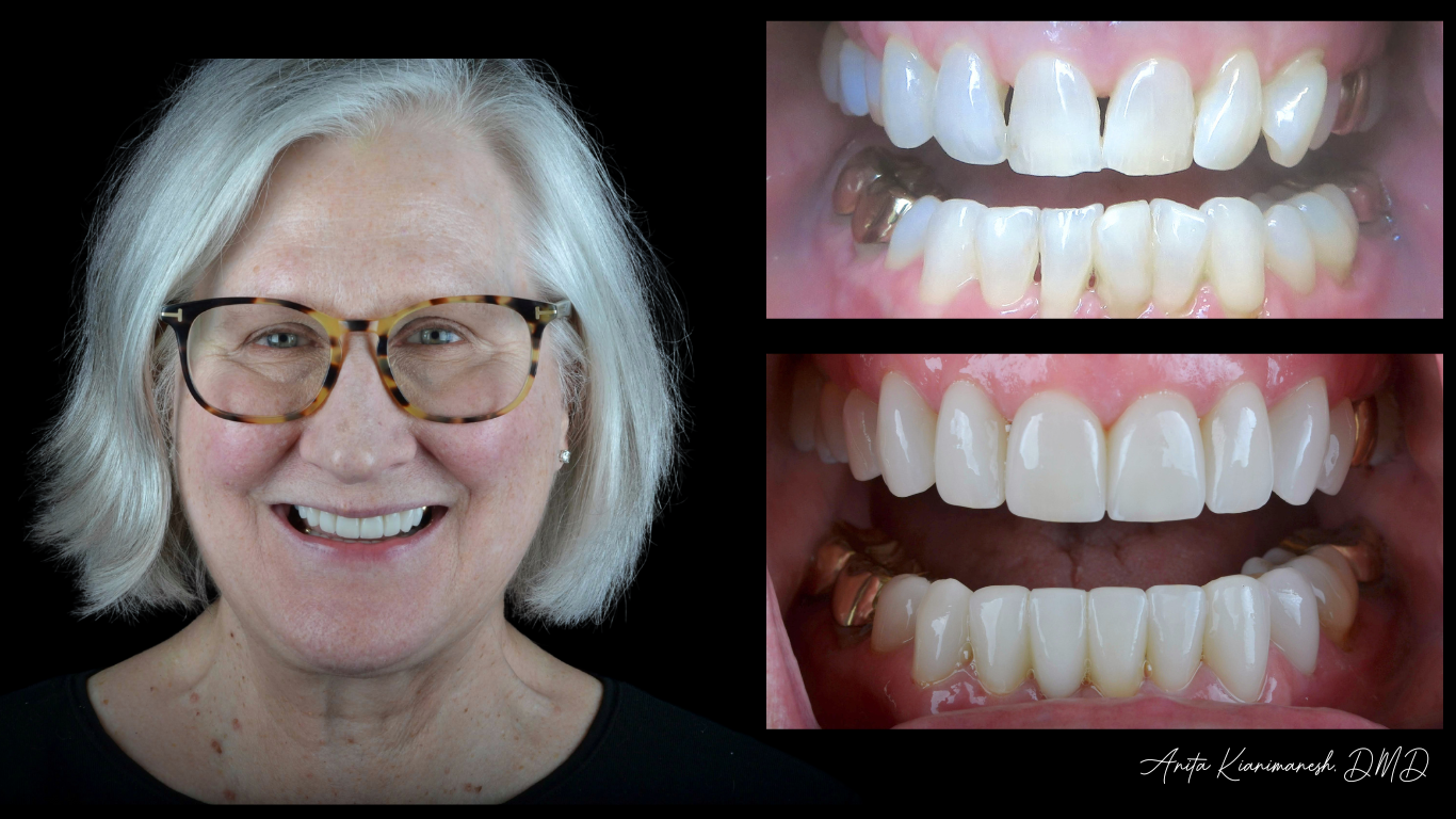 Smile Makeover