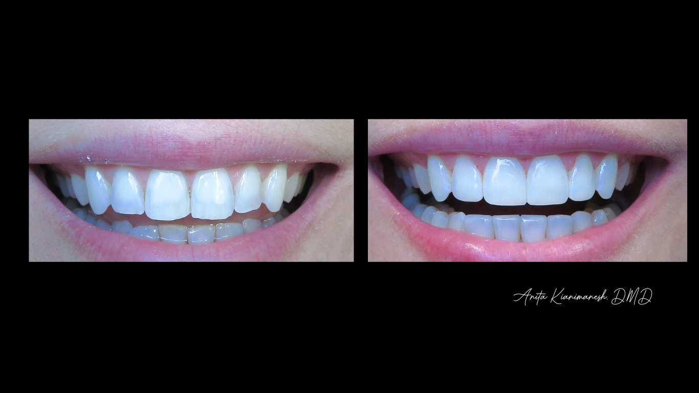  Invisalign and Composite Bonding 