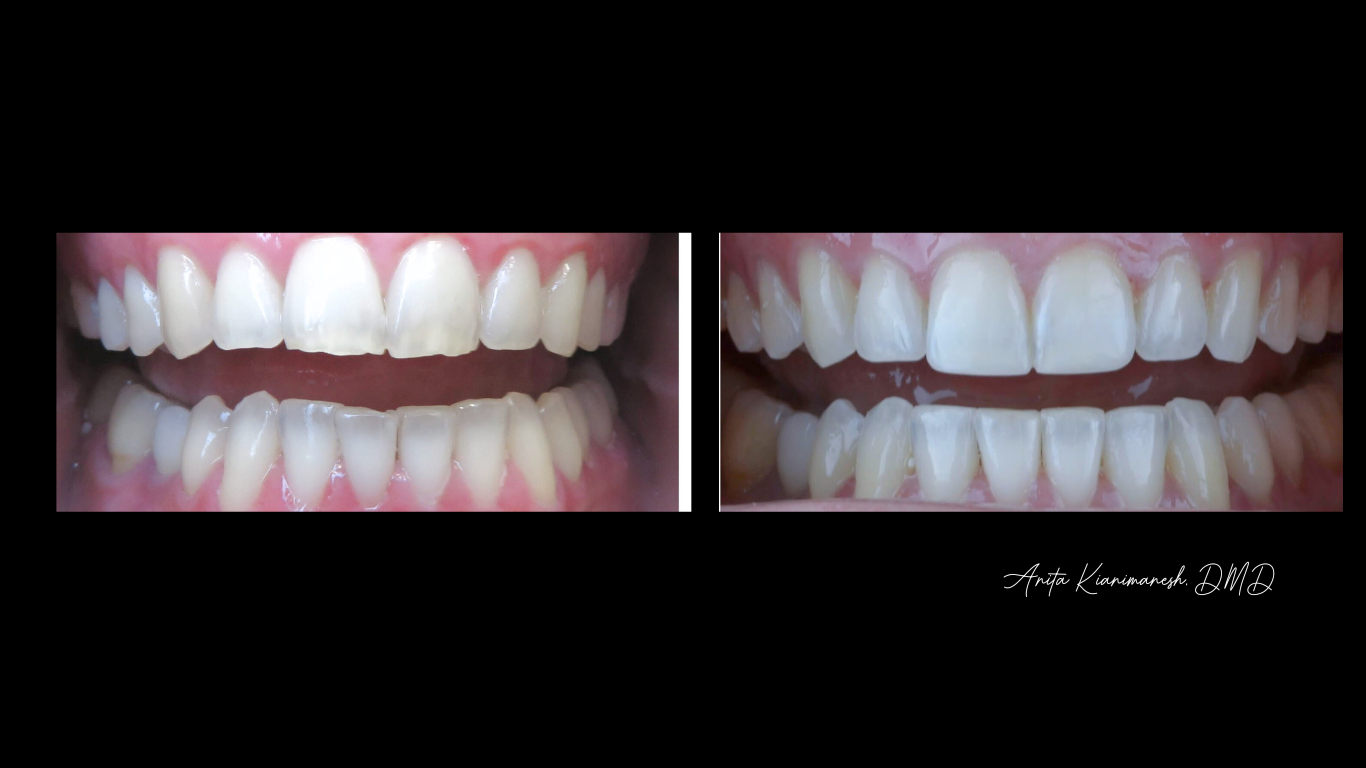 Invisalign and Bonding
