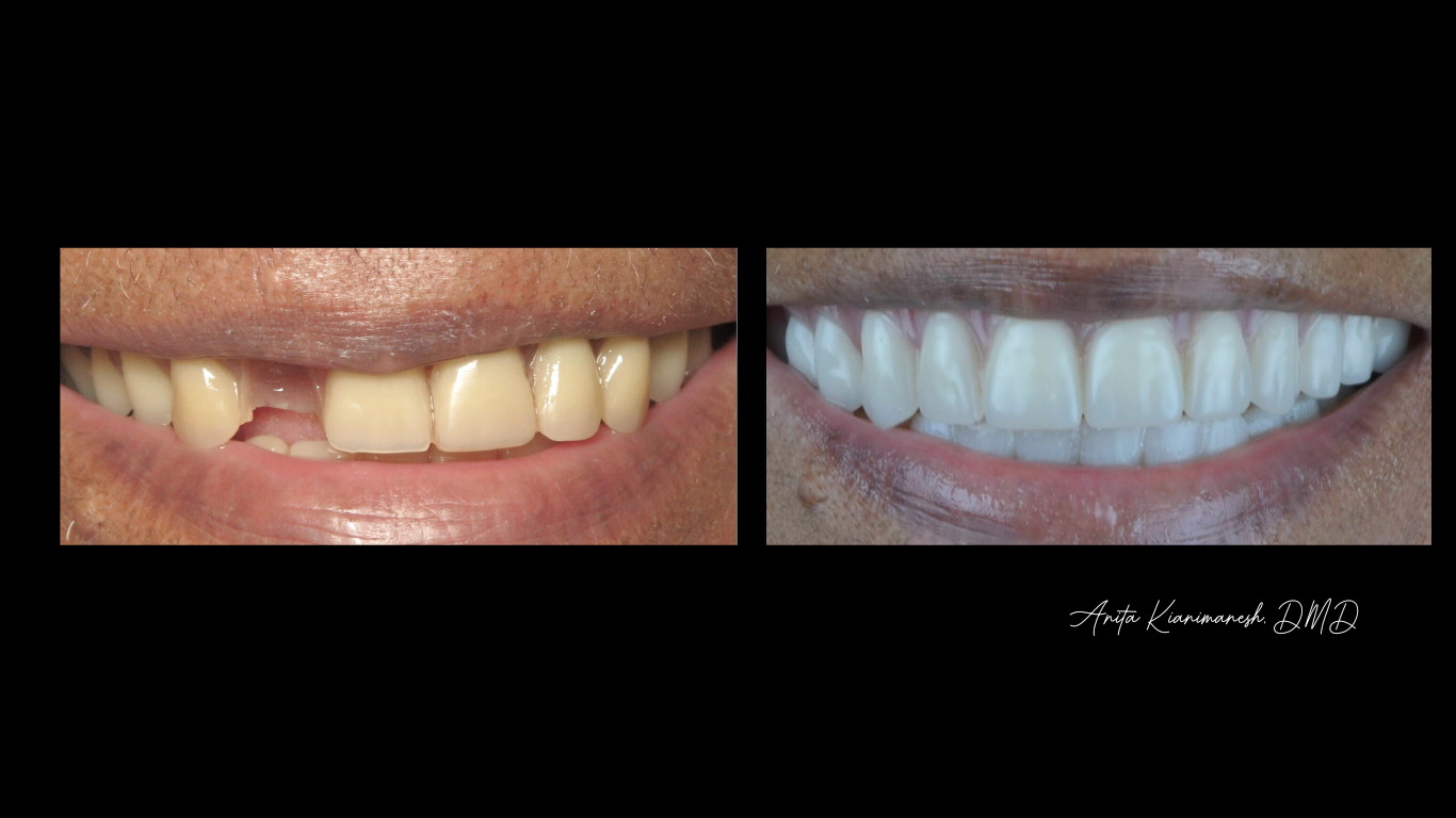 Dentures 