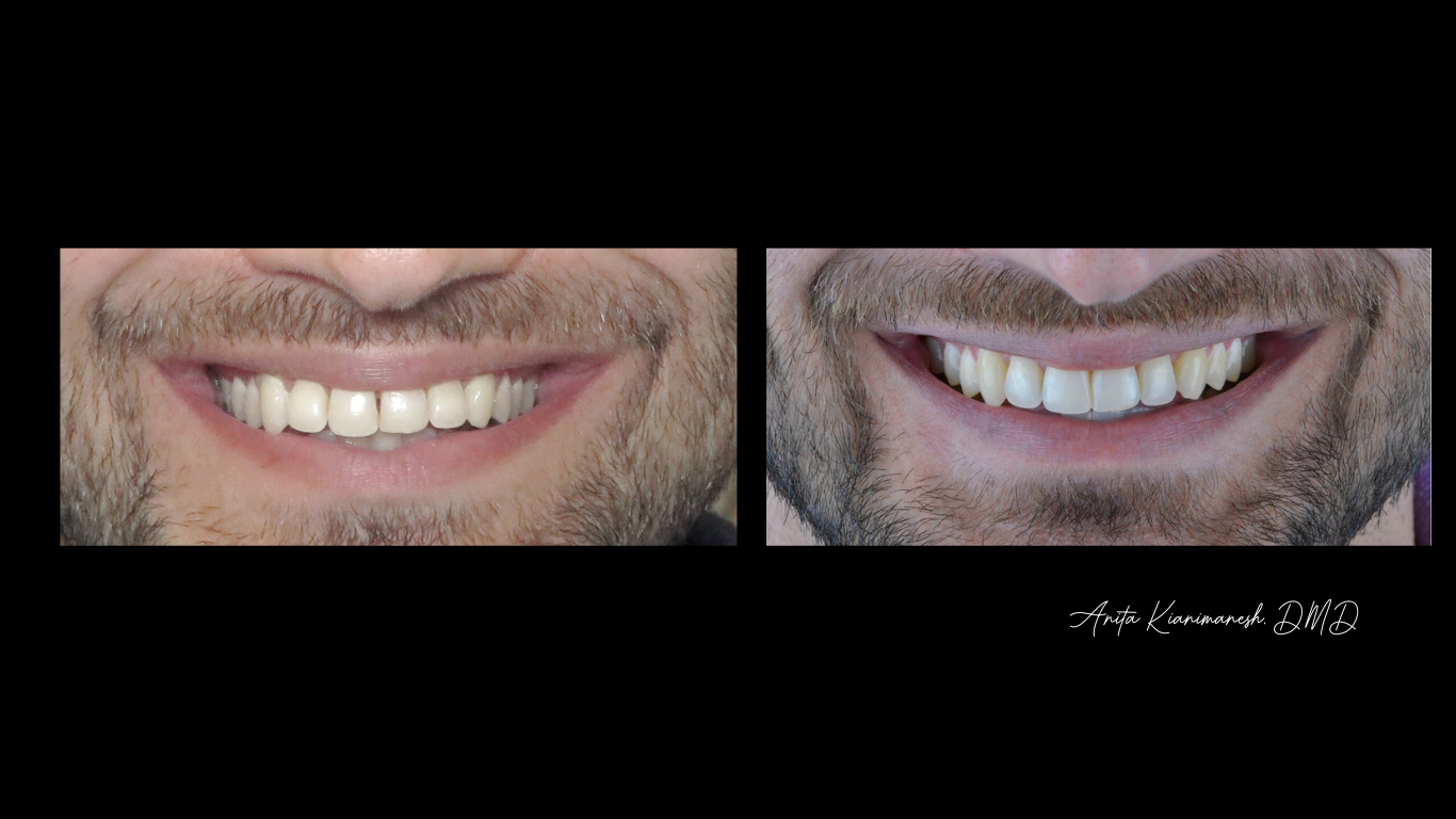 Invisalign and Bonding