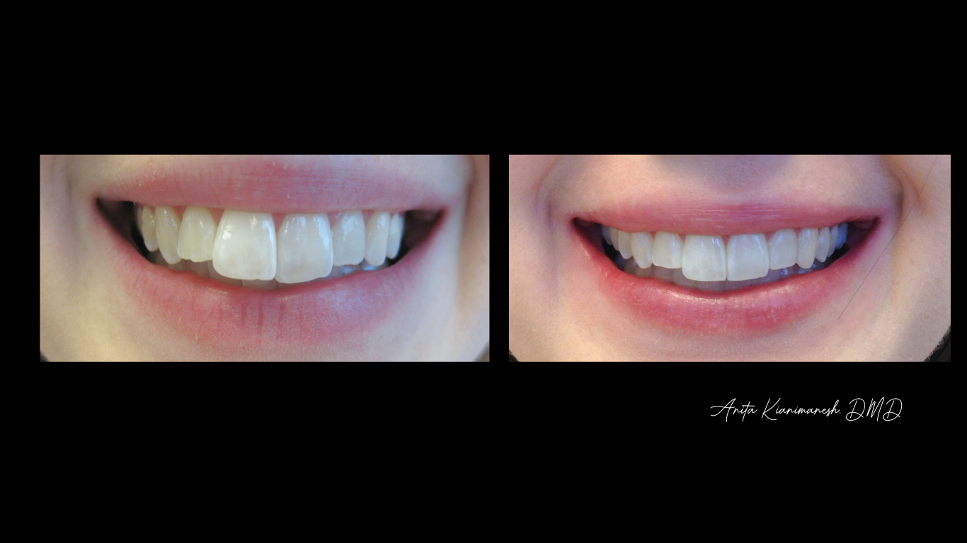 Invisalign and Bondings