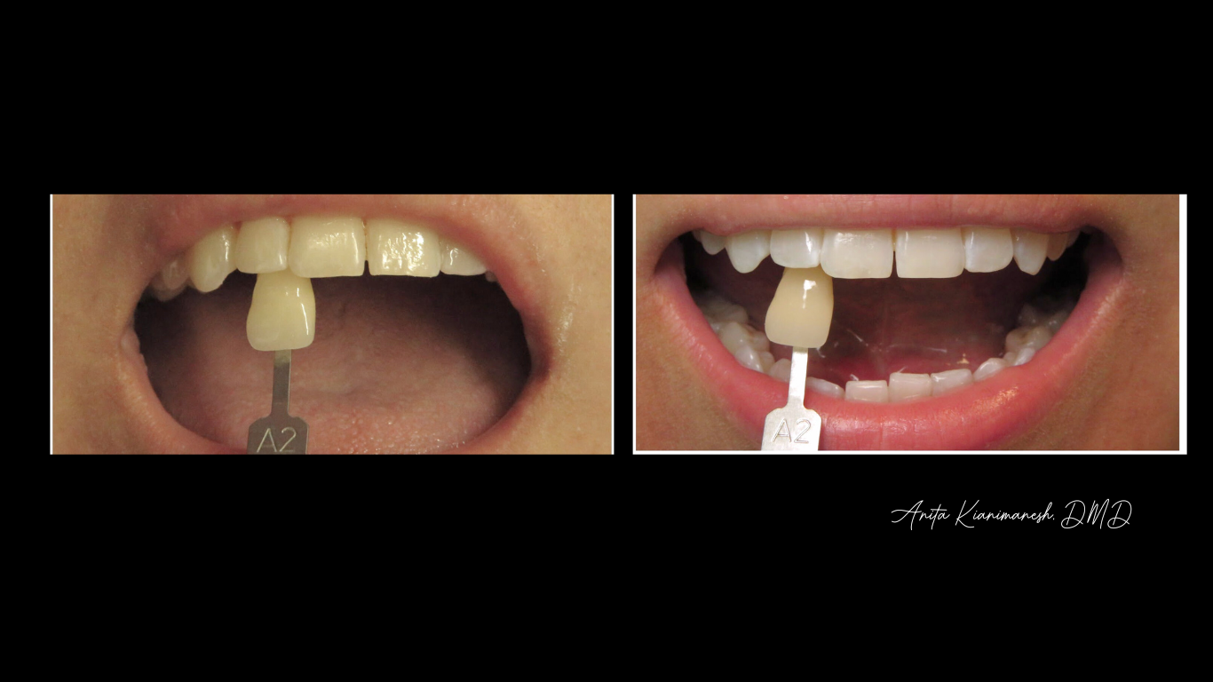Zoom Whitening