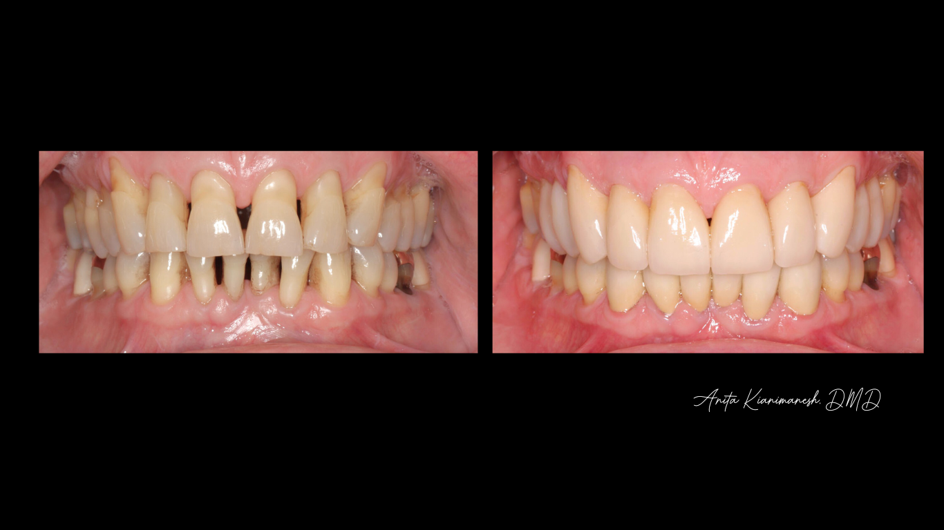 Smile makeover