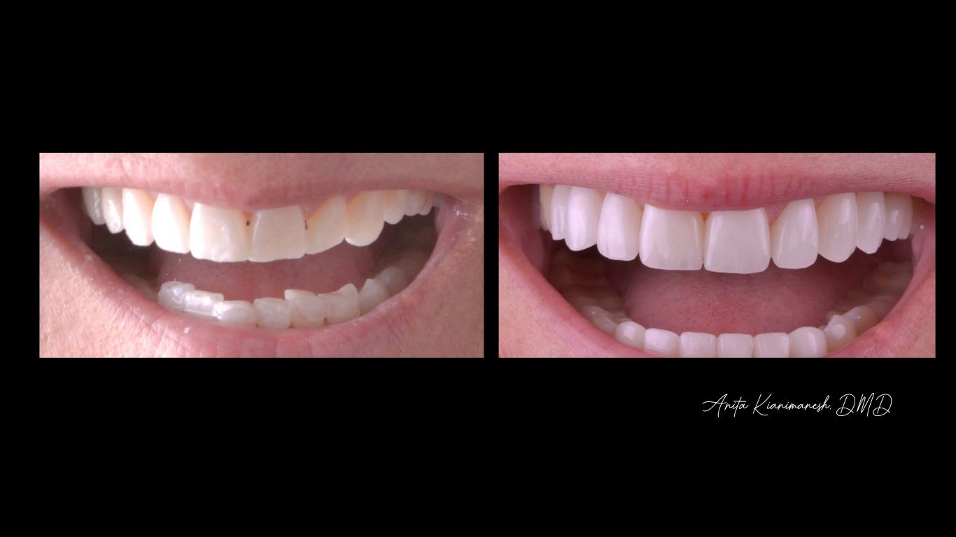 Invisalign and Bondings