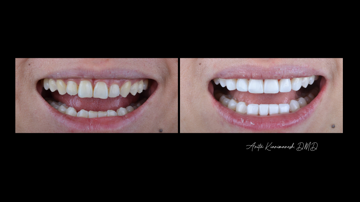 Invisalign and Bondings