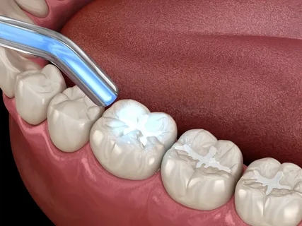 Tooth Colored Fillings