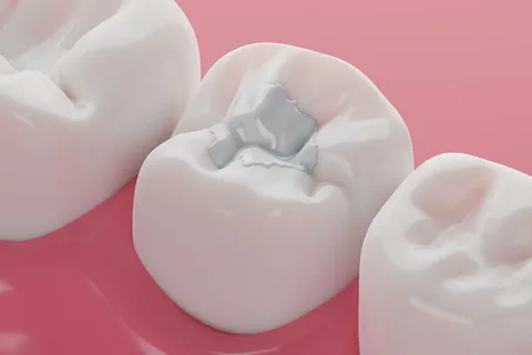 Tooth Colored Fillings