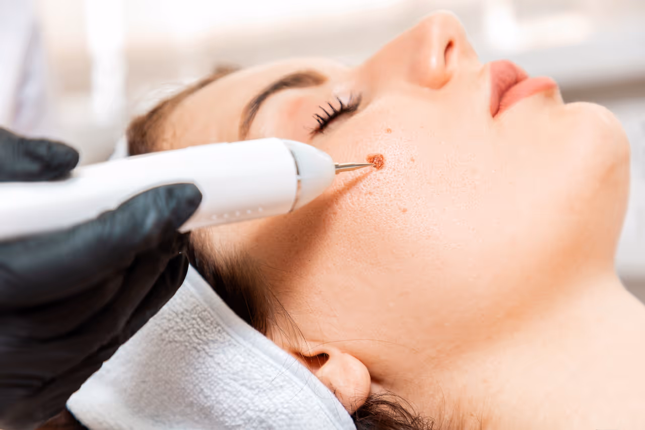 Wart Removal in La Jolla, CA
