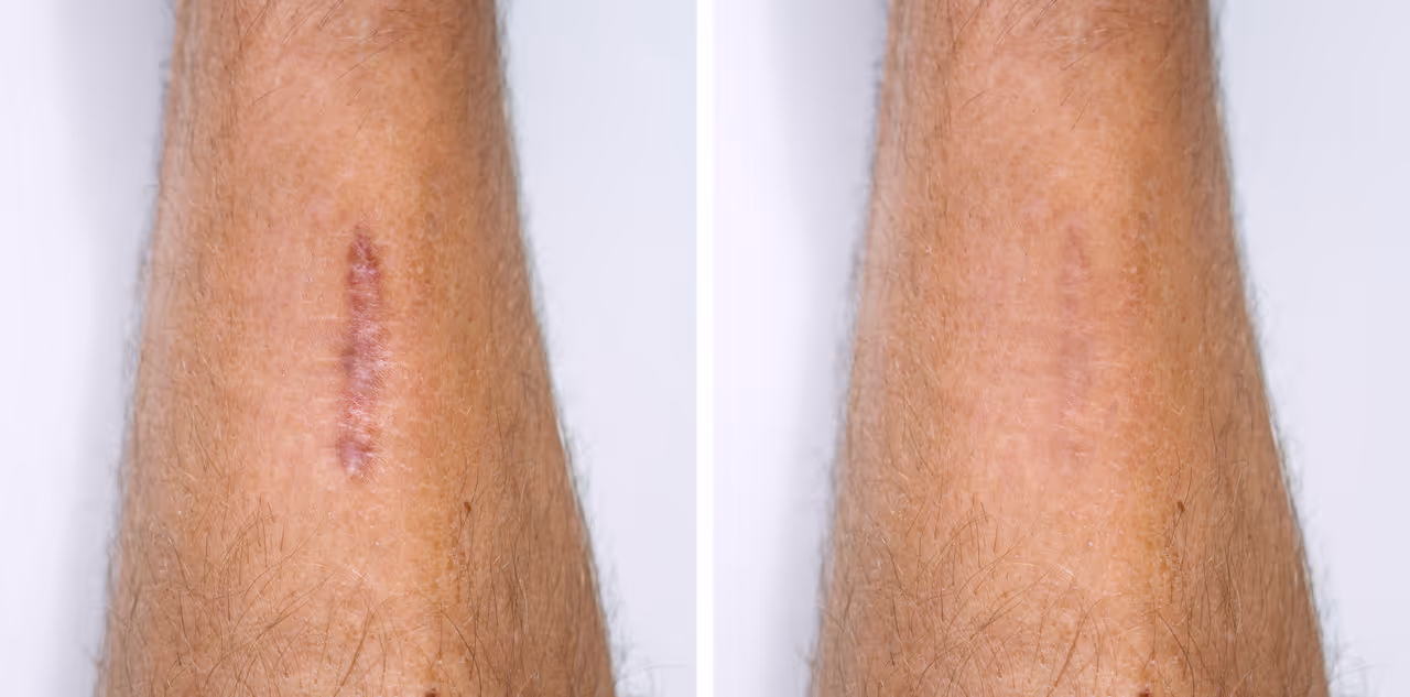 Scar Tissue Removal in La Jolla, CA