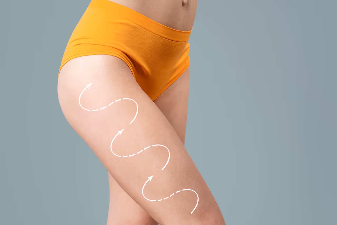 Cellulite Reduction in La Jolla, CA