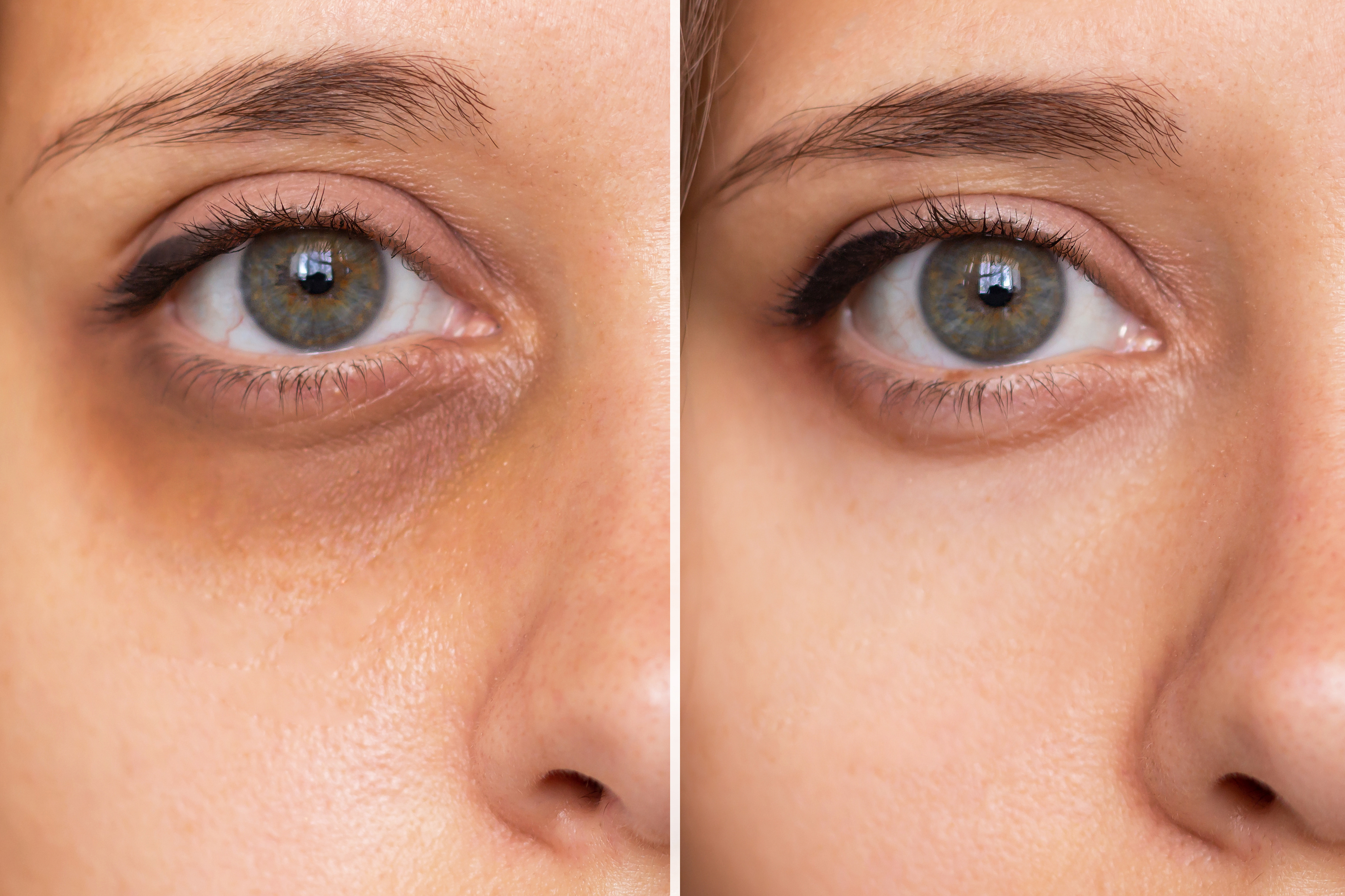 How Can I Fix Dark Circles and Under-Eye Hollows Without Surgery?