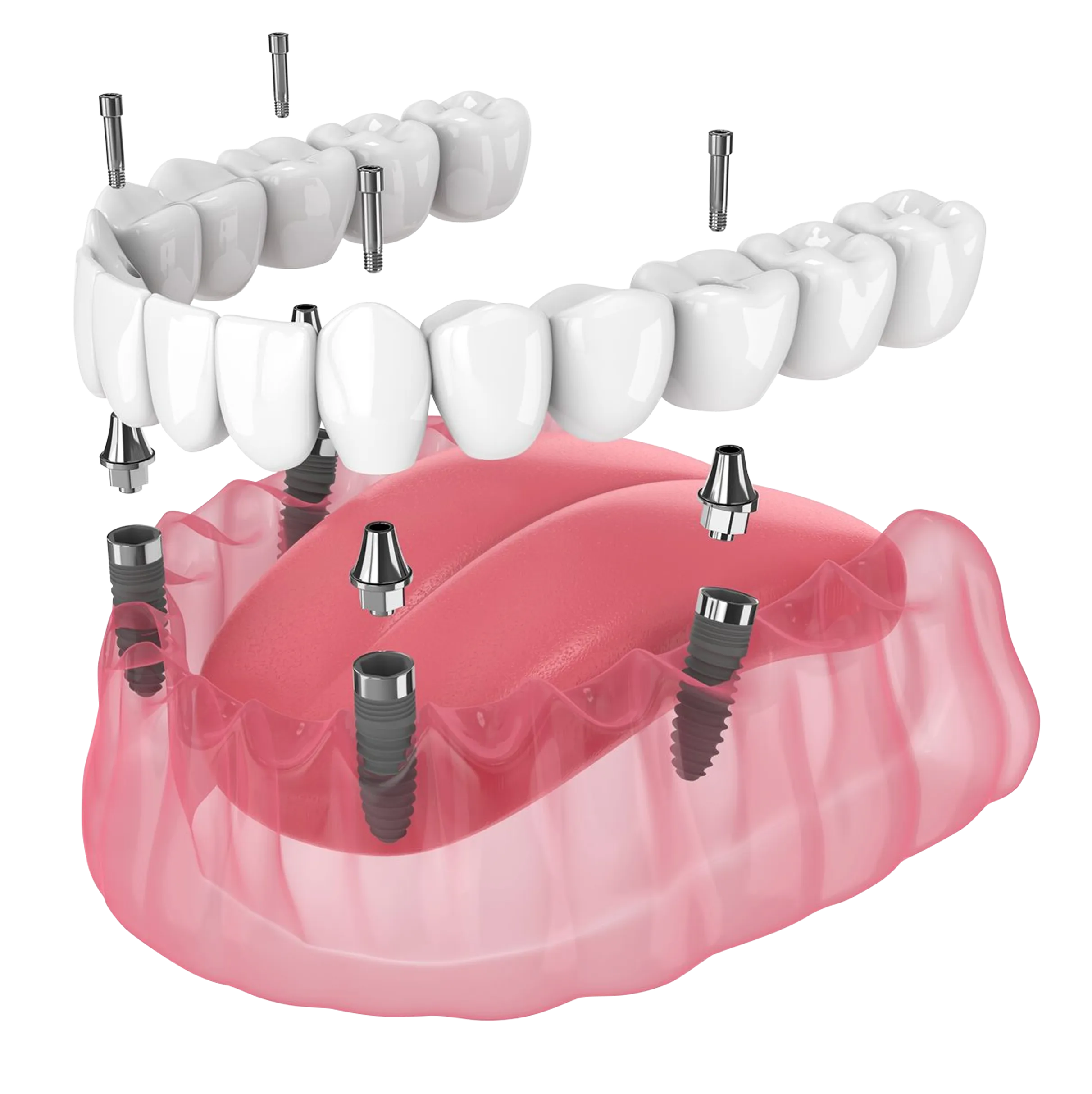 A dental model of teeth with implants attached to them.