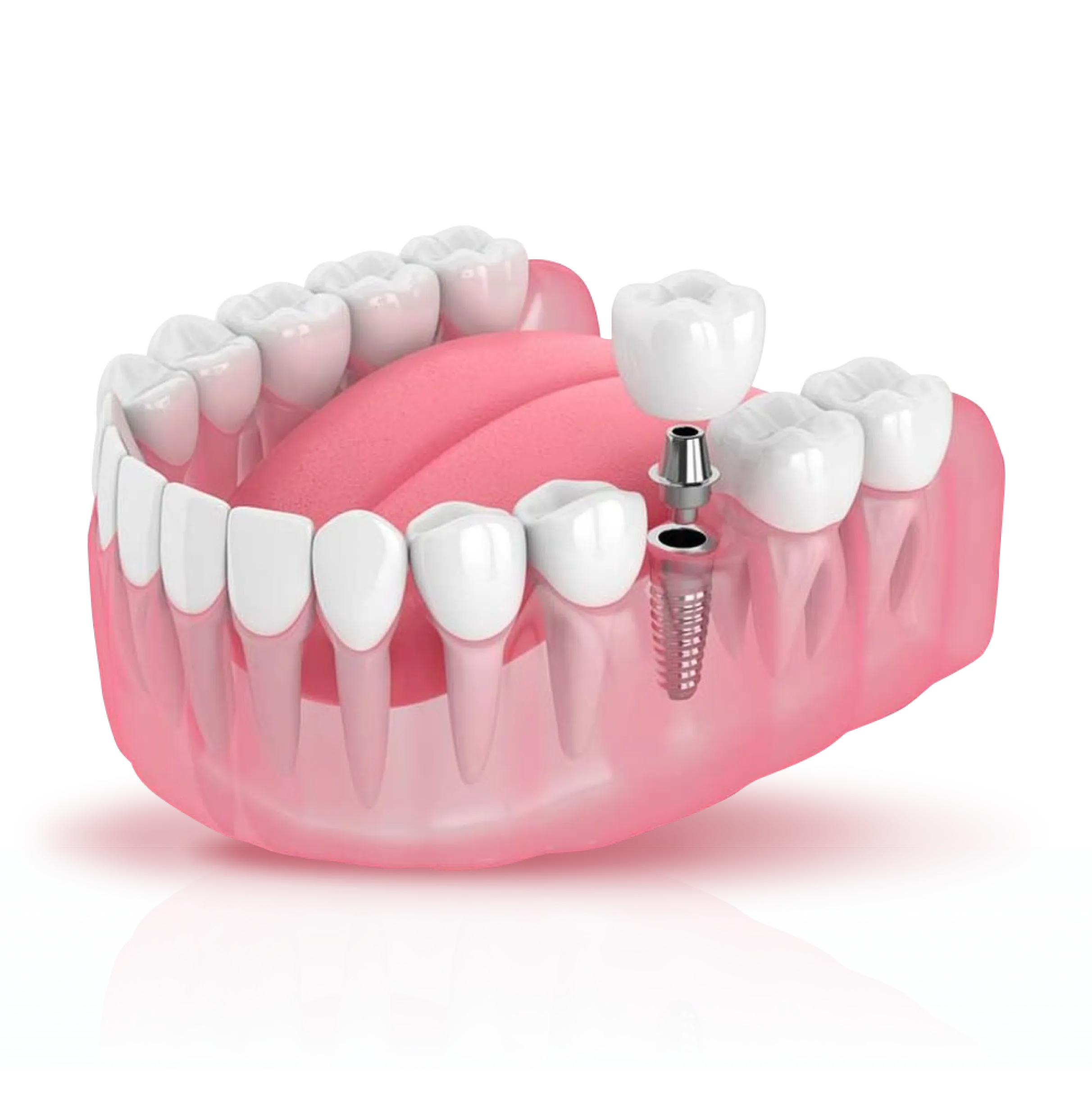 A tooth with a screw in the middle of it.