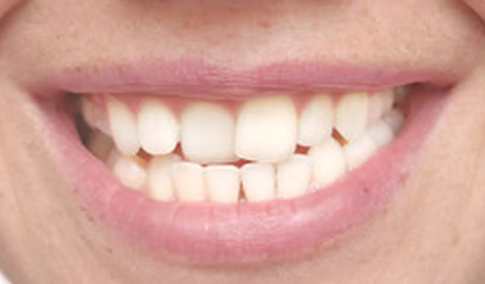 A close up of a person's mouth with a missing tooth.