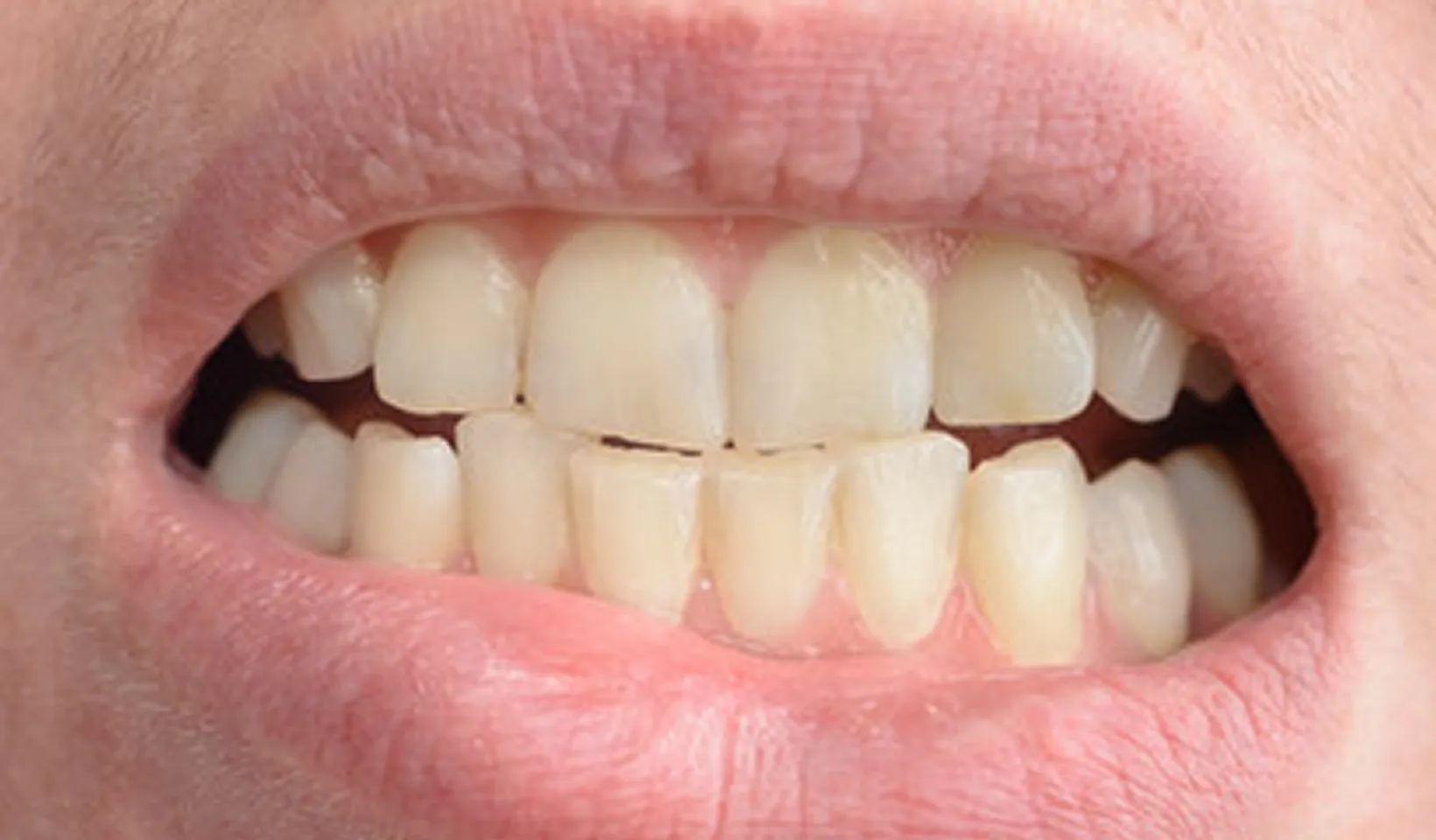A close up of a person's mouth with a missing tooth.