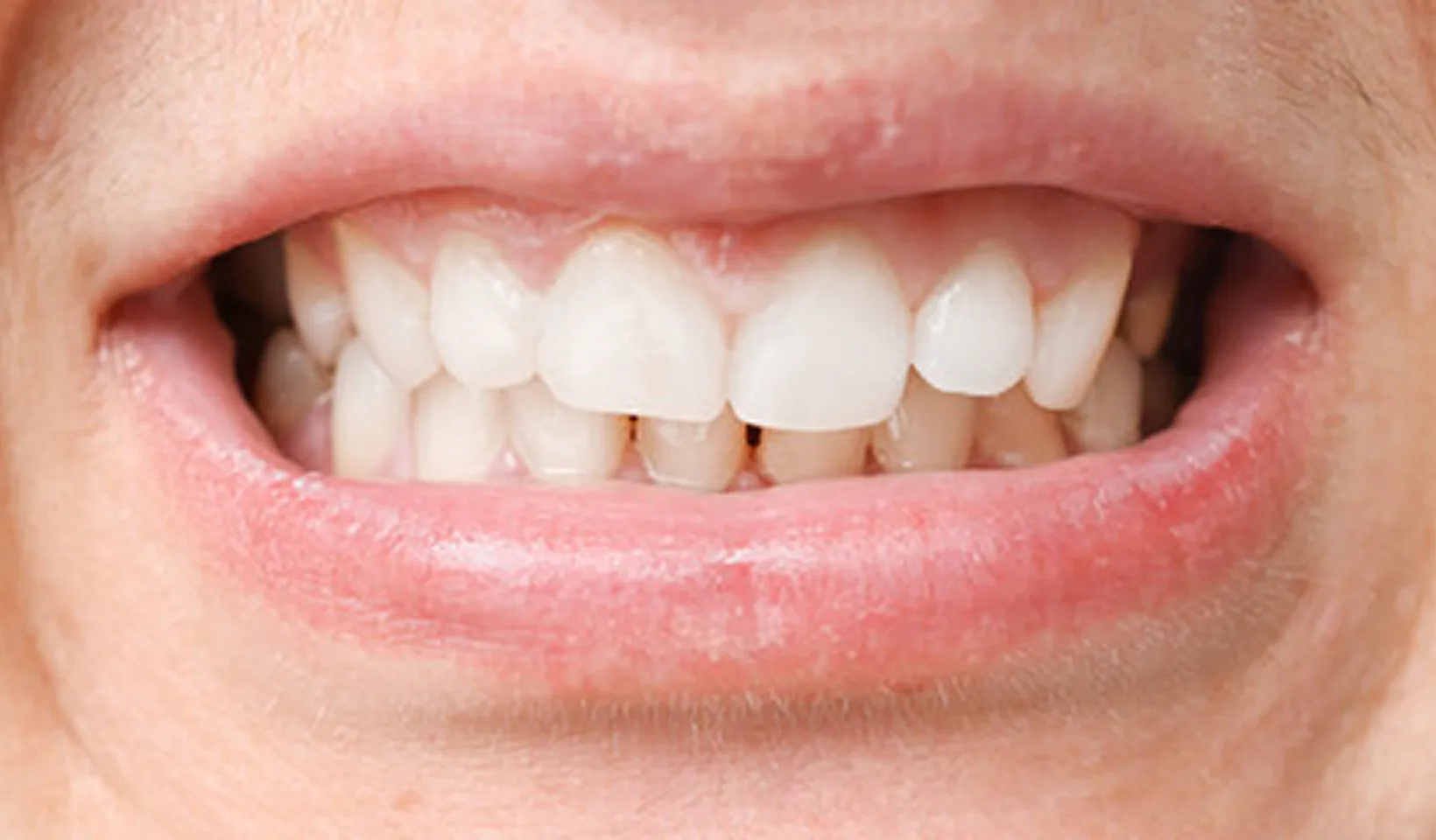 A close up of a person's mouth with a missing tooth.