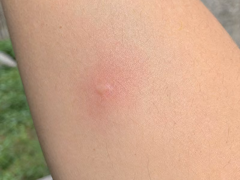 red mosquito bite