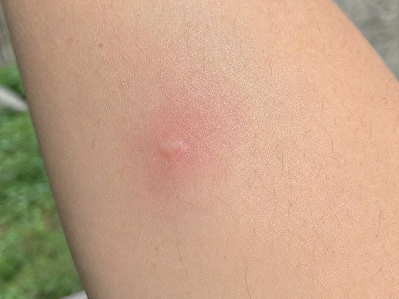 red mosquito bite