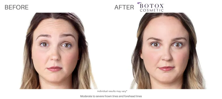 botox results