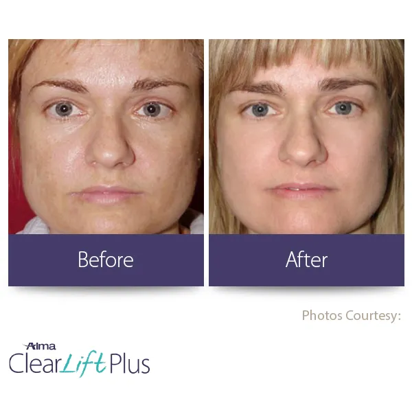clearlift results from laser treatment