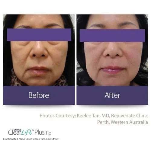 clearlift results from laser treatment