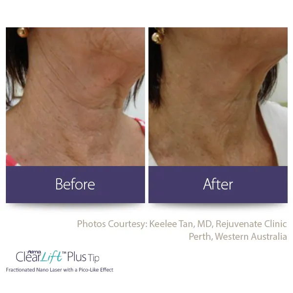 clearlift results from laser treatment