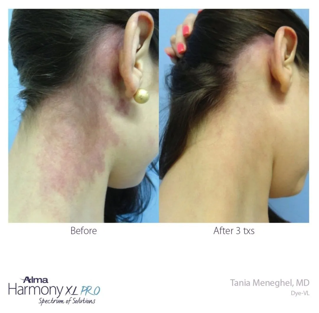 dye vl results from laser treatment