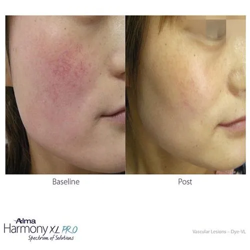dye vl results from laser treatment