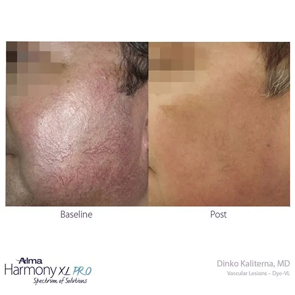 dye vl results from laser treatment