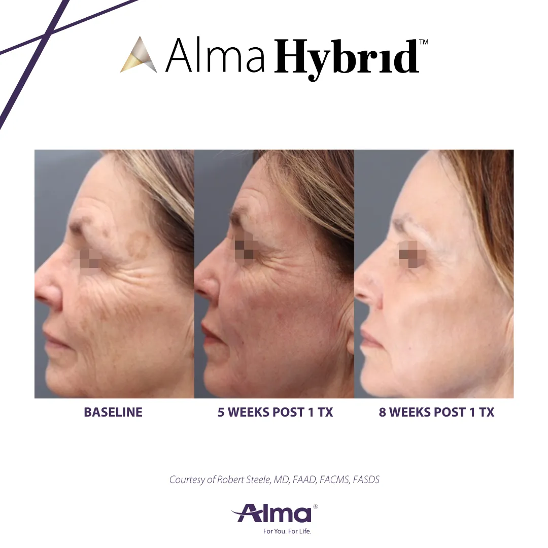 hybrid results laser treatment 