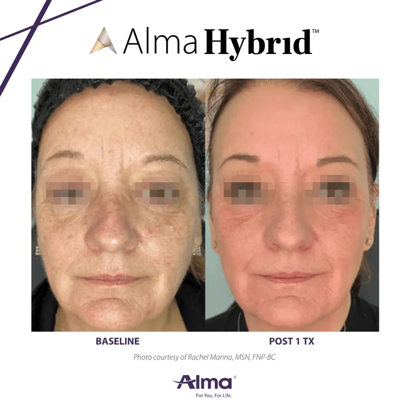hybrid results laser treatment