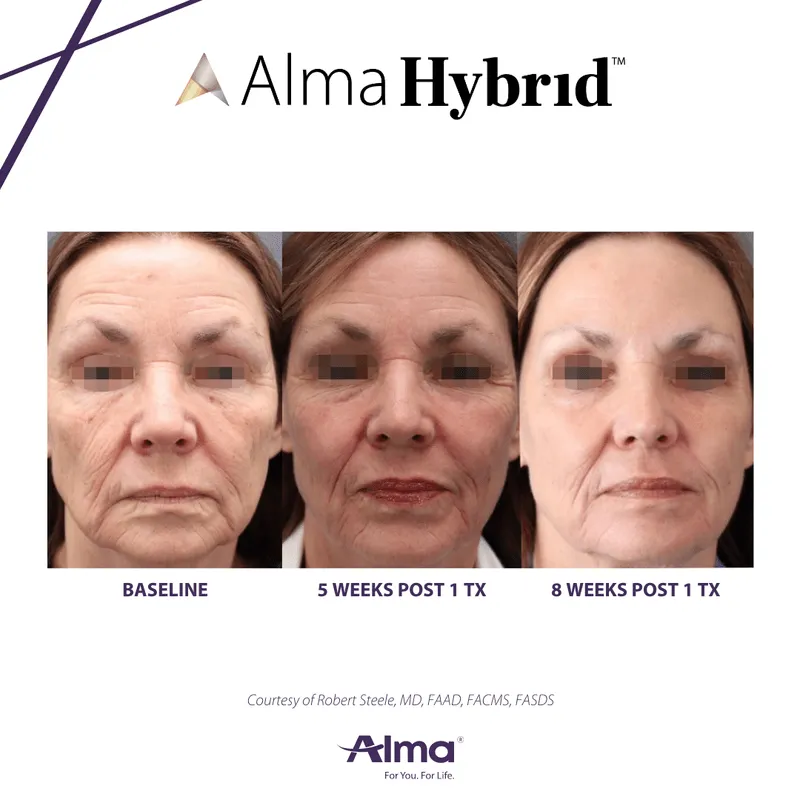 hybrid results laser treatment