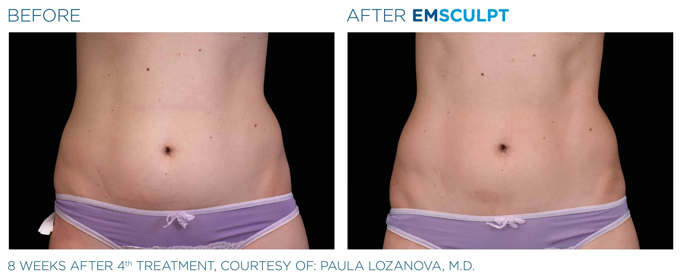 emsculpt results for body contouring