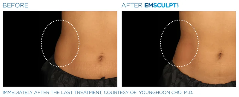 emsculpt results for body contouring