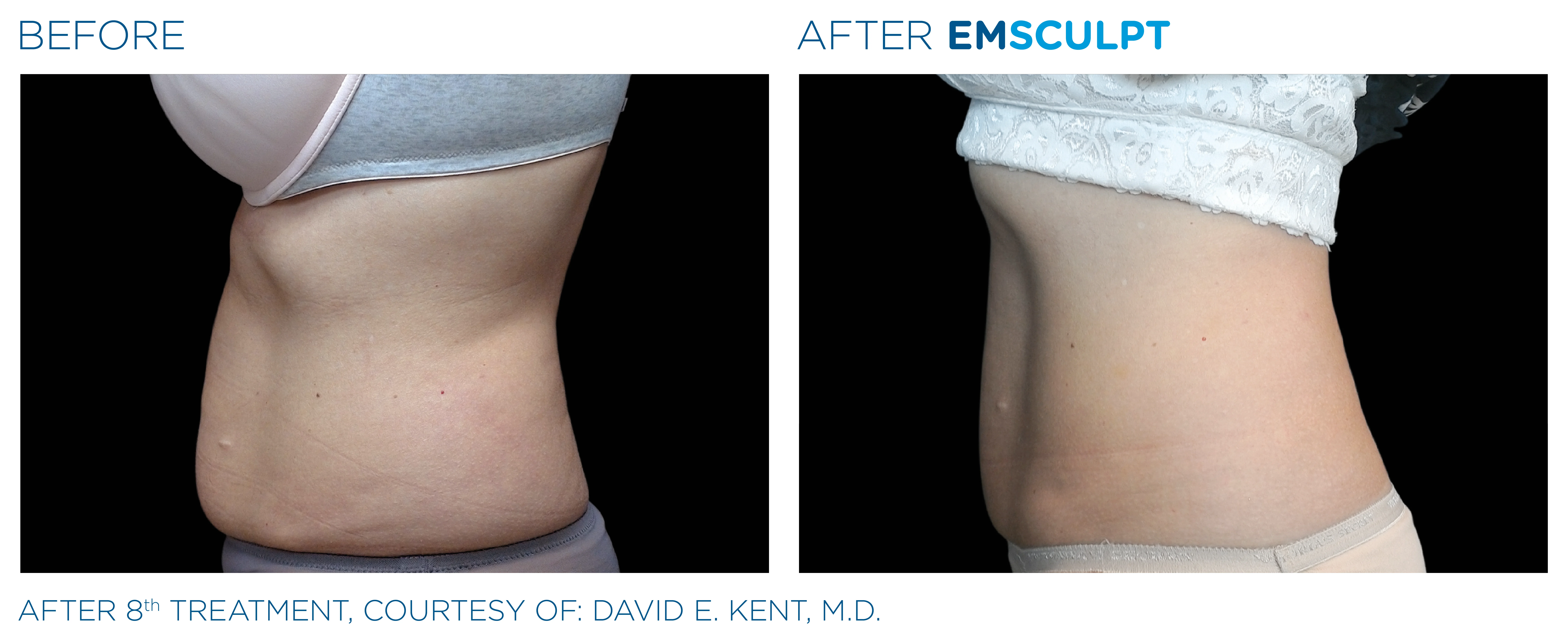 emsculpt results for body contouring