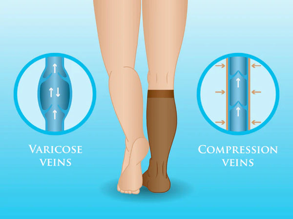 Image illustracting what compression does to the veins.