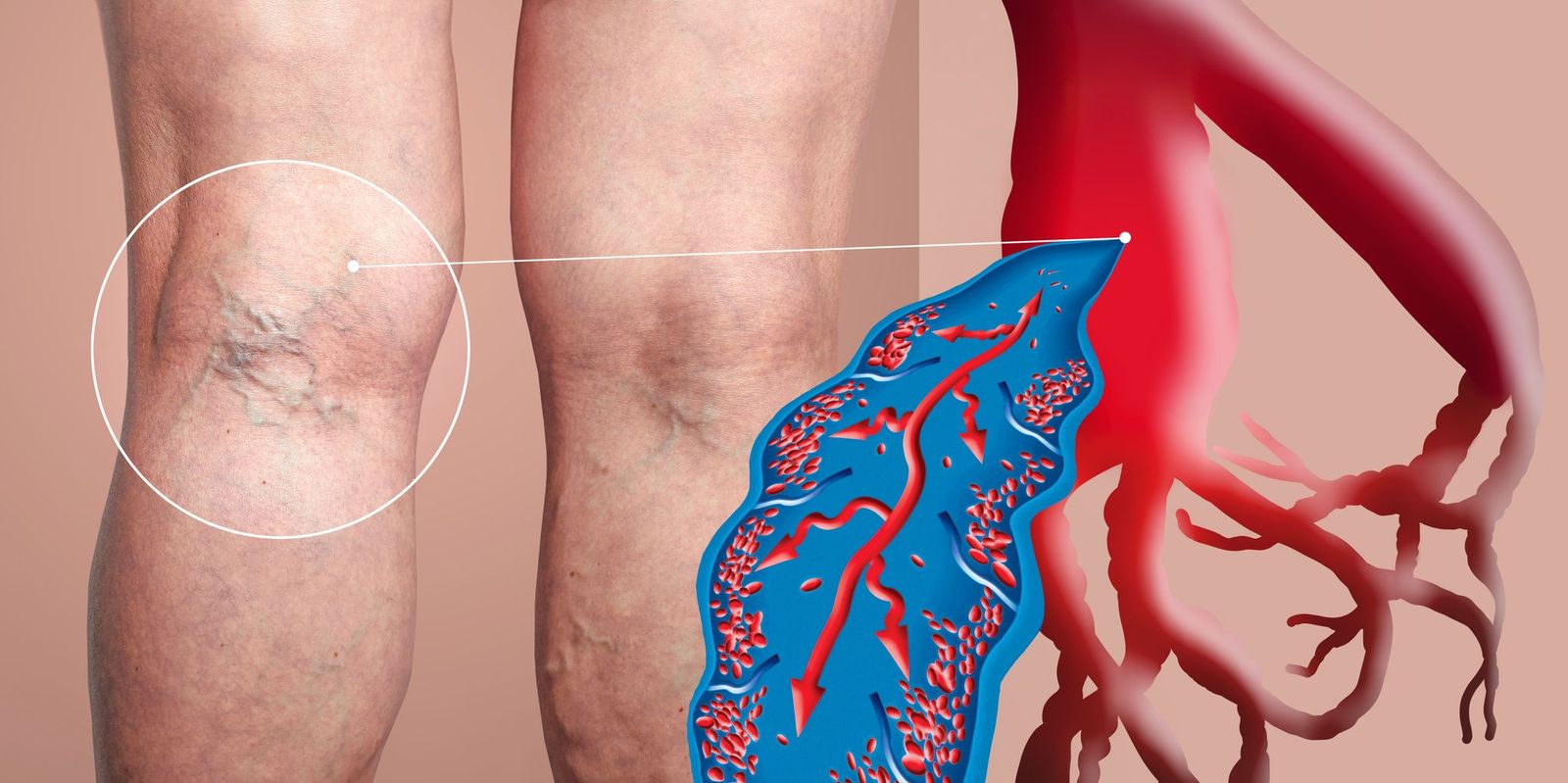close up view of what causes varicose veins