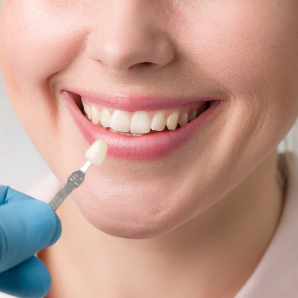 photo of a dentist trying to determine the perfect shade for a female patient's whitening treatment