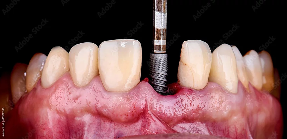 Dental Implants