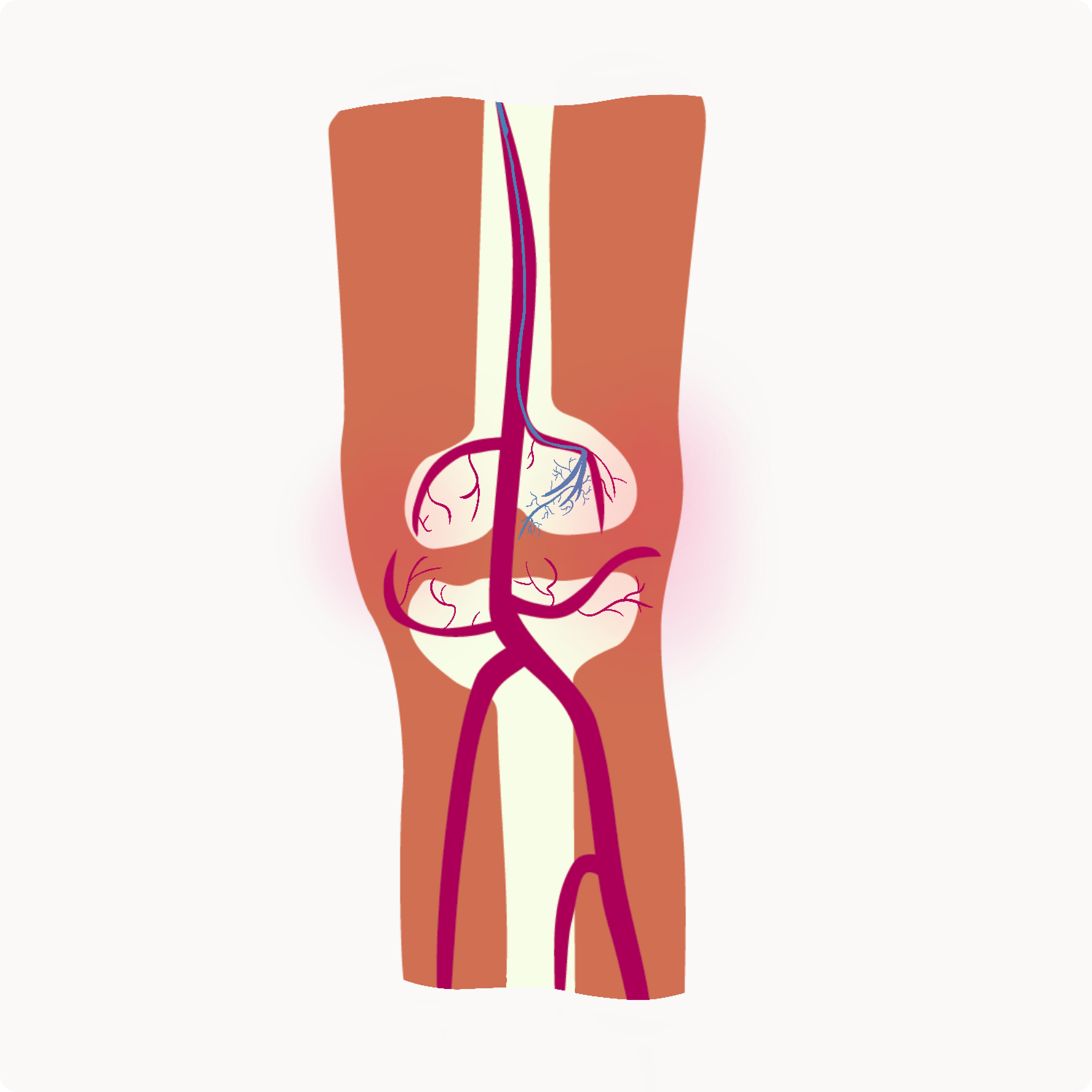 A diagram of the image-guided GAE procedure through the knee.
