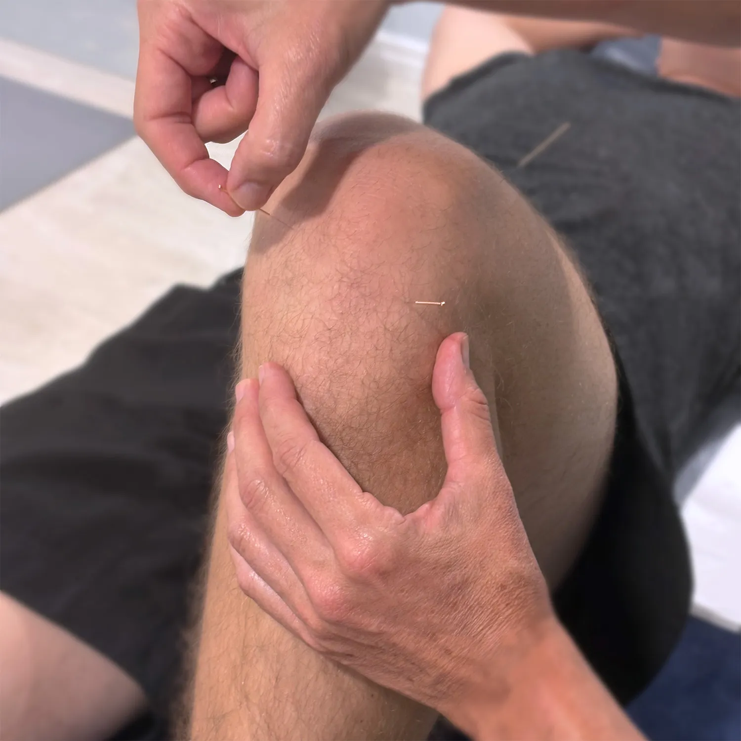Close-up of a person's knee receiving acupuncture treatment with small needles inserted into the skin and a practitioner's hands gently positioning a needle.