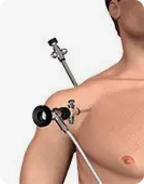 Shoulder Arthroscopy