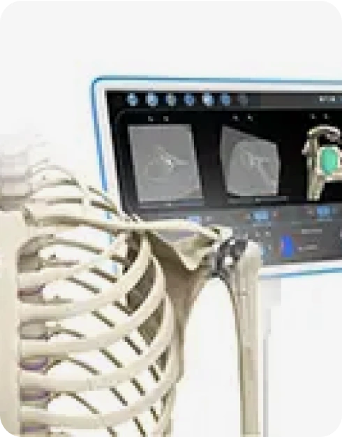 Computer Navigation for Shoulder Replacement