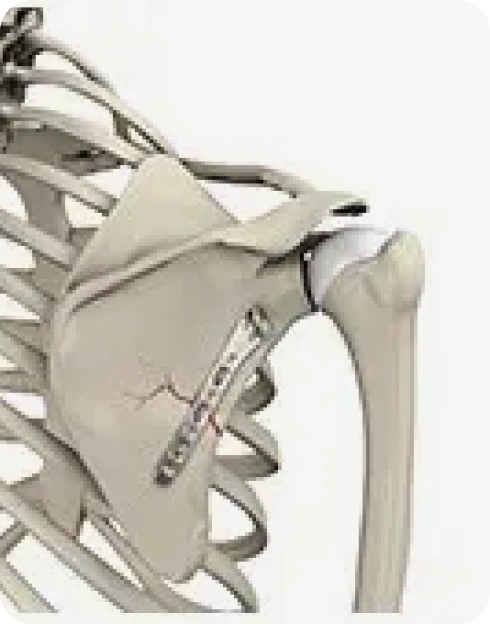 Shoulder Fracture Care