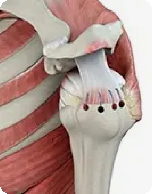 Rotator Cuff Repair