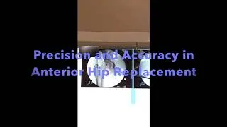 Leg Length Anterior Hip Replacement