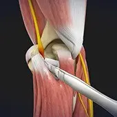 Cubital Tunnel Release